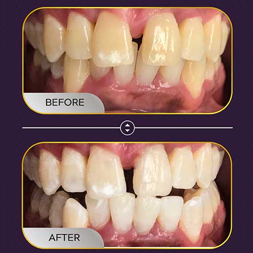 teethwhiteningbeforeandafter03 Mobile Dentist In Detroit Michigan