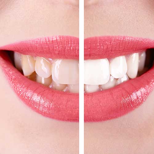 teethwhiteningtransformation Mobile Dentist In Detroit Michigan